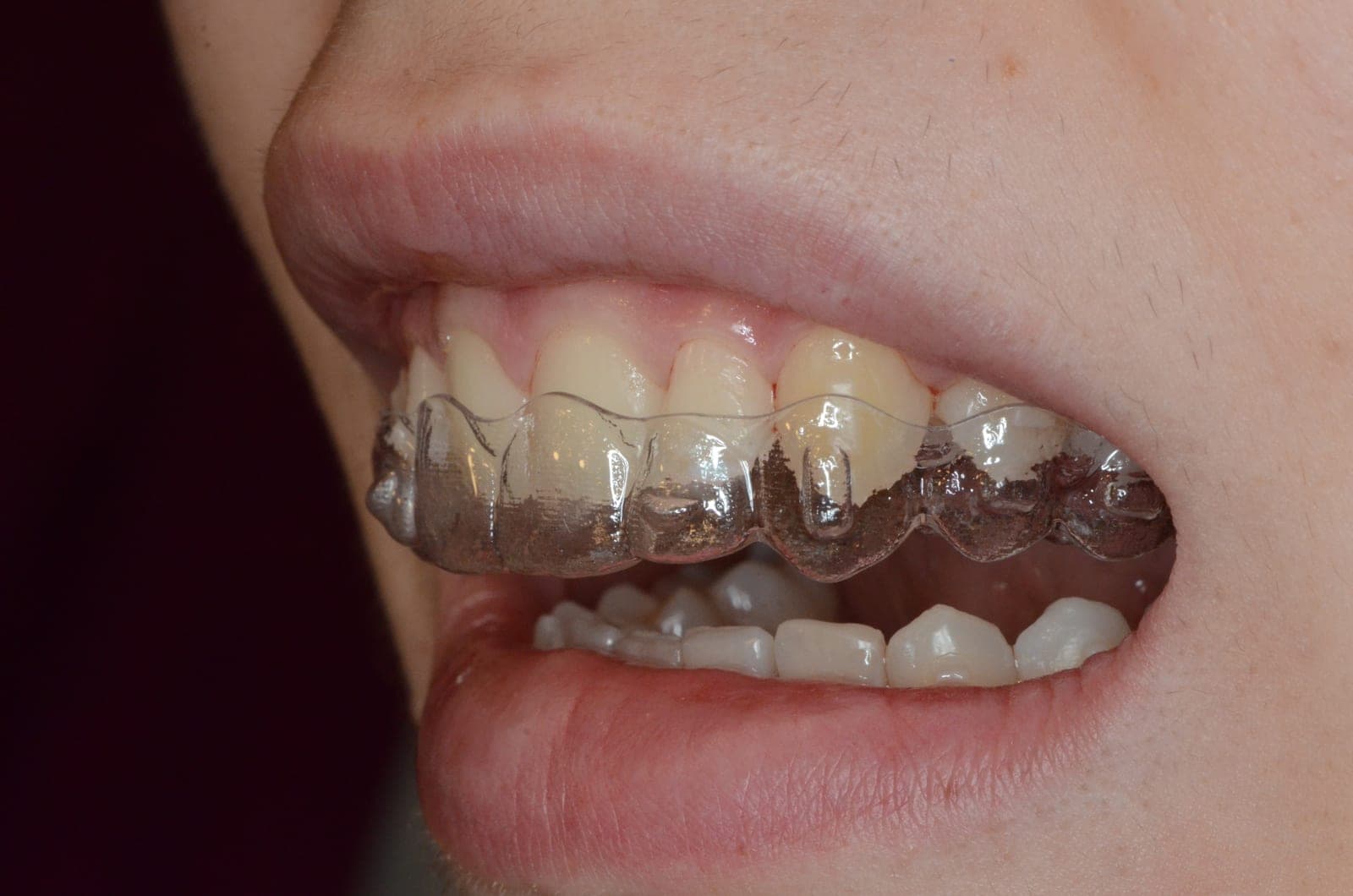 Allineatore trasparente per ortodonzia invisibile - Studio Dentistico Lolli